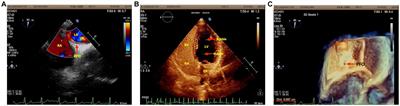 Case report: Anxiety and depression as initial symptoms in a patient with acute hypoxia and patent foramen ovale